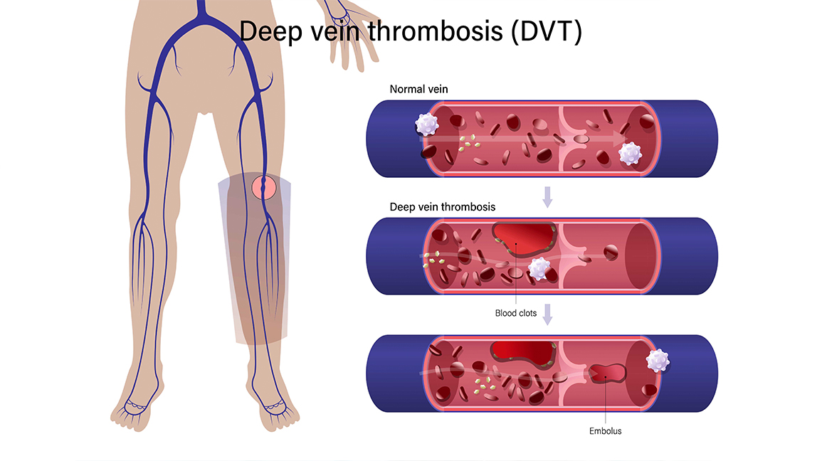 Deep Vein Thrombosis: Causes, Symptoms, Risk Factors, Diagnosis, Treatment,  Prevention and Complications